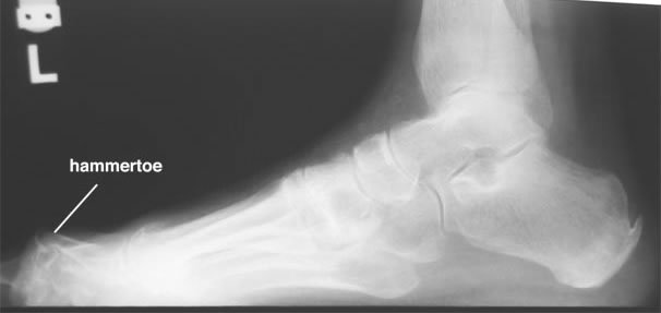 My3DPrinting's tweet image. #AdditiveOrthopaedics Develops #3DPrinted Implant to Successfully Treat #Hammertoes
3dprint.com/141935/3d-prin…
