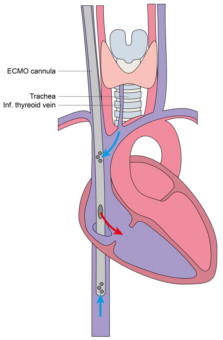 FOAMecmo's tweet photo. Is percutaneous dilatational tracheostomy safe on VV #ECMO? 2 cases of fatal air embolism https://t.co/CgZBBZkJef https://t.co/5ACbFMw2sD