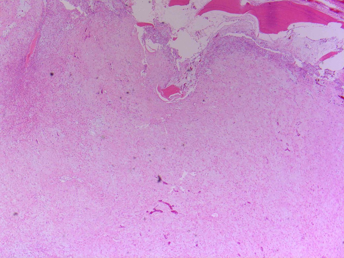 Brendan Dickson, MD on Twitter "CHONDROMYXOID FIBROMA. NB spindle