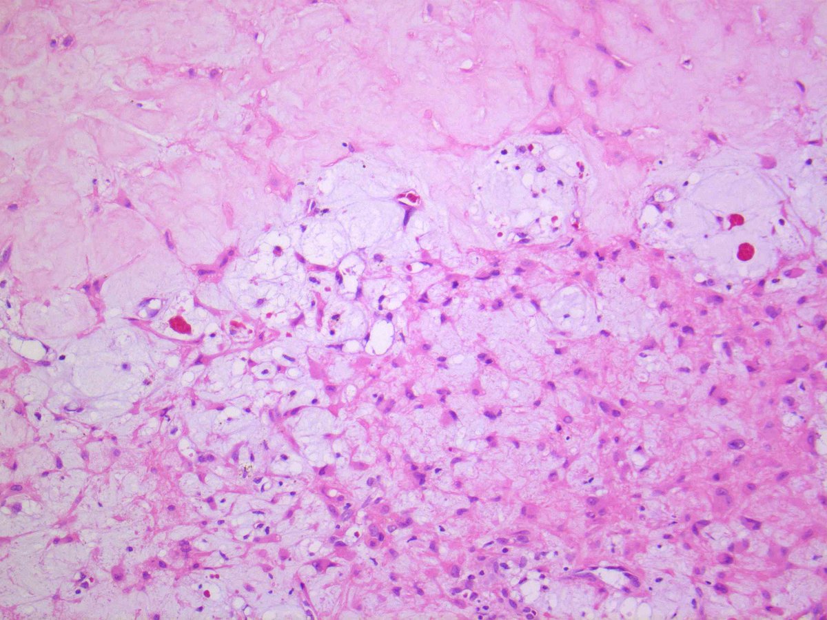Brendan Dickson, MD on Twitter "CHONDROMYXOID FIBROMA. NB spindle