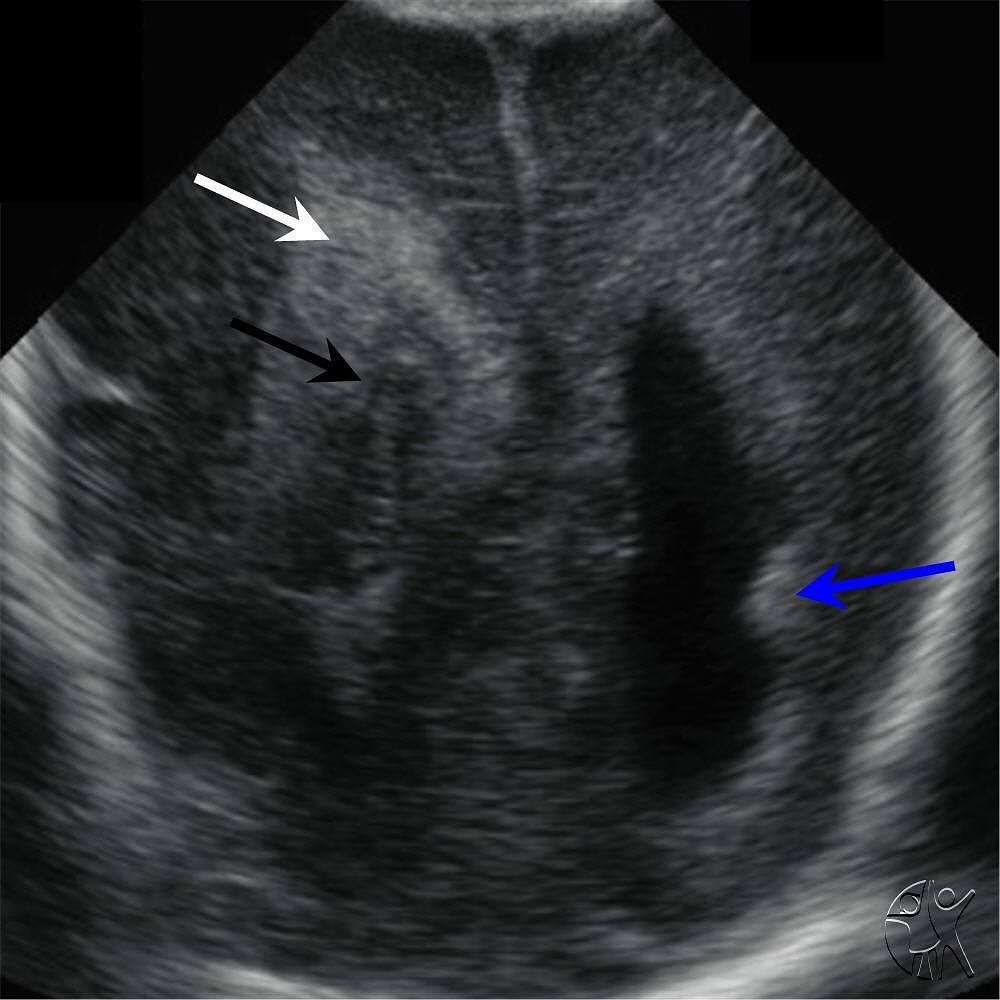 CincyKidsRad's tweet photo. Coronal head US in an extremely premature newborn shows right Grade IV intraventricular he… https://t.co/GLP1styzLu https://t.co/HieGJJ2ChC