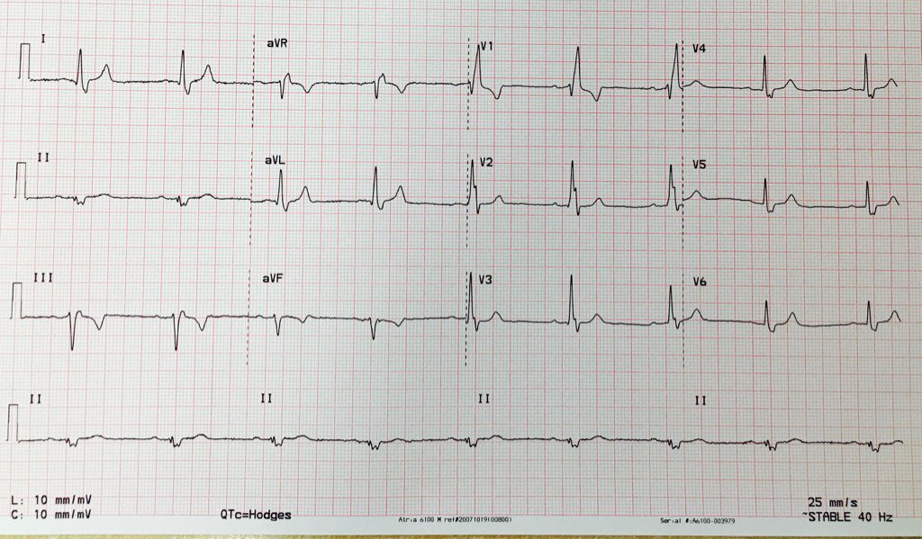 Dr_Connolly's tweet photo. What conduction abnormality is present here? #ECG #CardioEd https://t.co/GtPAGImZK1