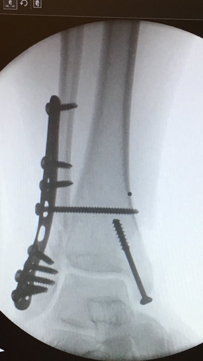 Sug2626's tweet photo. Surgeon had to put in major work to make my leg look this good. https://t.co/7iRGVTPrvH