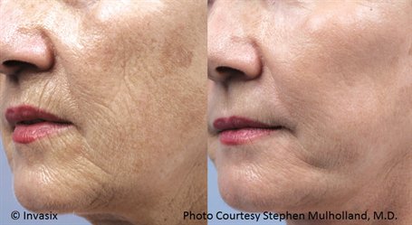Elite_Aesthetic's tweet photo. For the face, Fractora Firm can treat sagging skin on your face #fractora Models needed #modelrates #RF #fractora https://t.co/mS2lHLWevj