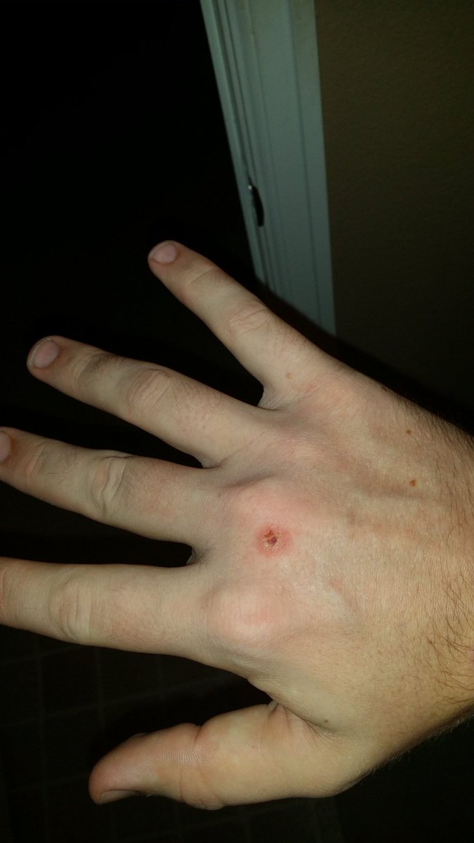 MatthewKeating7's tweet photo. Fun fact of last night, when you mess with my girl, I break my fist on your face.... Fair enough. https://t.co/oS1nAHst5t