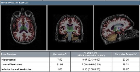 AaronBosterMD's tweet image. Hooray! @OhioHealthMS now using #neuroquant to provide atrophy measurements with our 3T MRI brain scans!