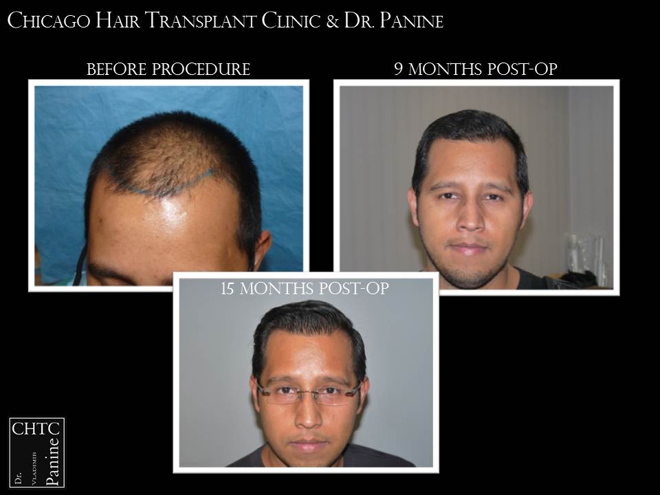 #ThursdayThoughts are updated #results from our #hairtransplant patient at 15 months. #hair #Chicago #getit