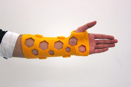 El yeso tiene sus días contados, <a href="/MediPrint3D/">MediPrint</a> imprime órtesis en 3D | goo.gl/64kl42