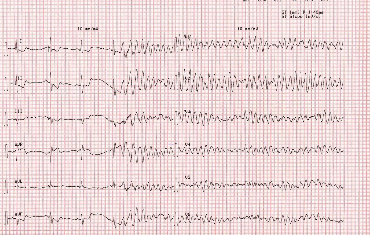 <a href="/LearnTheHeart/">Learn the Heart</a> like that ecg during treadmill ecg! after defirillation he had sinus rhytm.
