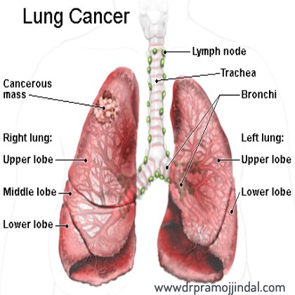 drpramojjindal.com/what-is-lung-c…

#Lung Cancer #Surgeon in #Delhi
