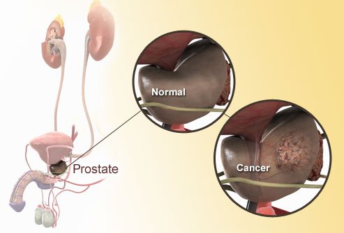 authorcystein's tweet photo. ~220,000 men in the US were diagnosed w/#prostatecancer in 2015.
85% will be cured
Read more>https://t.co/T8v4lDBpSU https://t.co/Vlgc3yLEfj