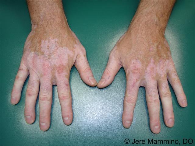 GingerPineda1's tweet photo. When I was a child I used to believe that use chlorine in hands, caused the disease vitiligo. #IB600 @bravocelex https://t.co/KfcxdeyyJE