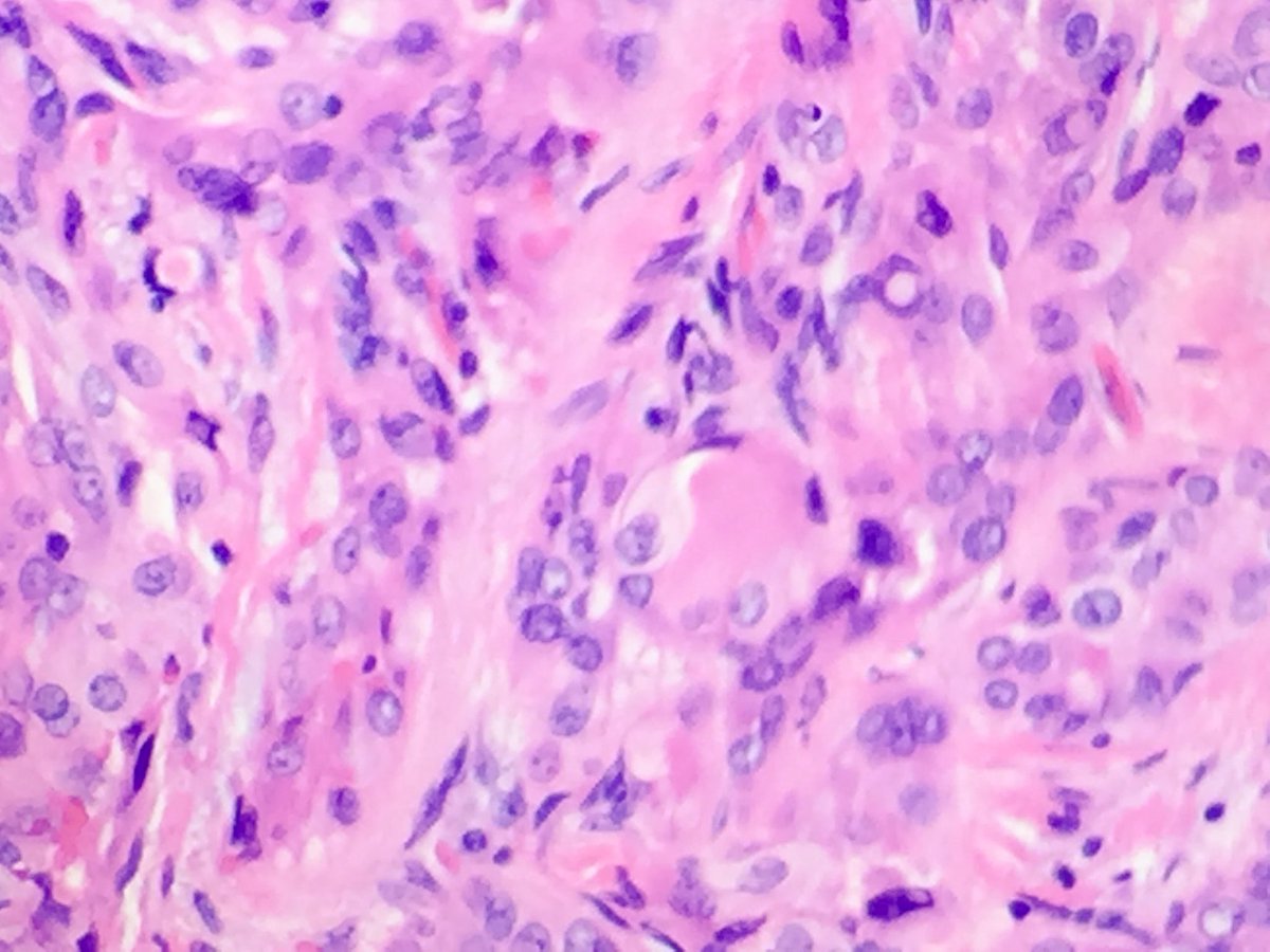 NRiddleMD's tweet photo. Such pretty intranuclear pseudoinclusions #PTC #ThyroidCa https://t.co/AqYrMfltea