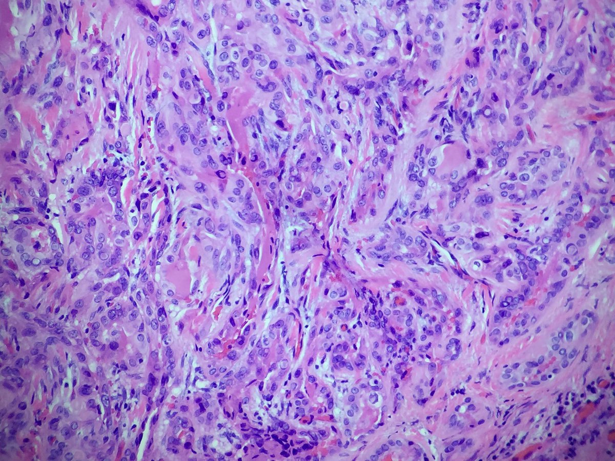 NRiddleMD's tweet photo. Such pretty intranuclear pseudoinclusions #PTC #ThyroidCa https://t.co/AqYrMfltea