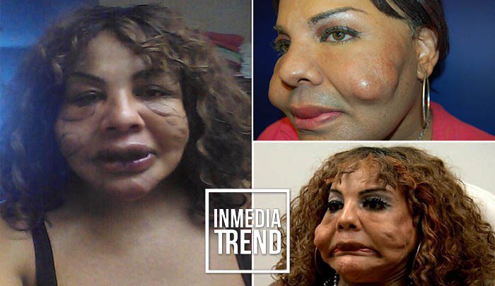 InmediaTrend's tweet photo. Mujer transgénero se inyectó cemento en la cara hace 10 años. Ahora, mira su transformación https://t.co/cmxKWDRq5x https://t.co/coUNT8vnRC