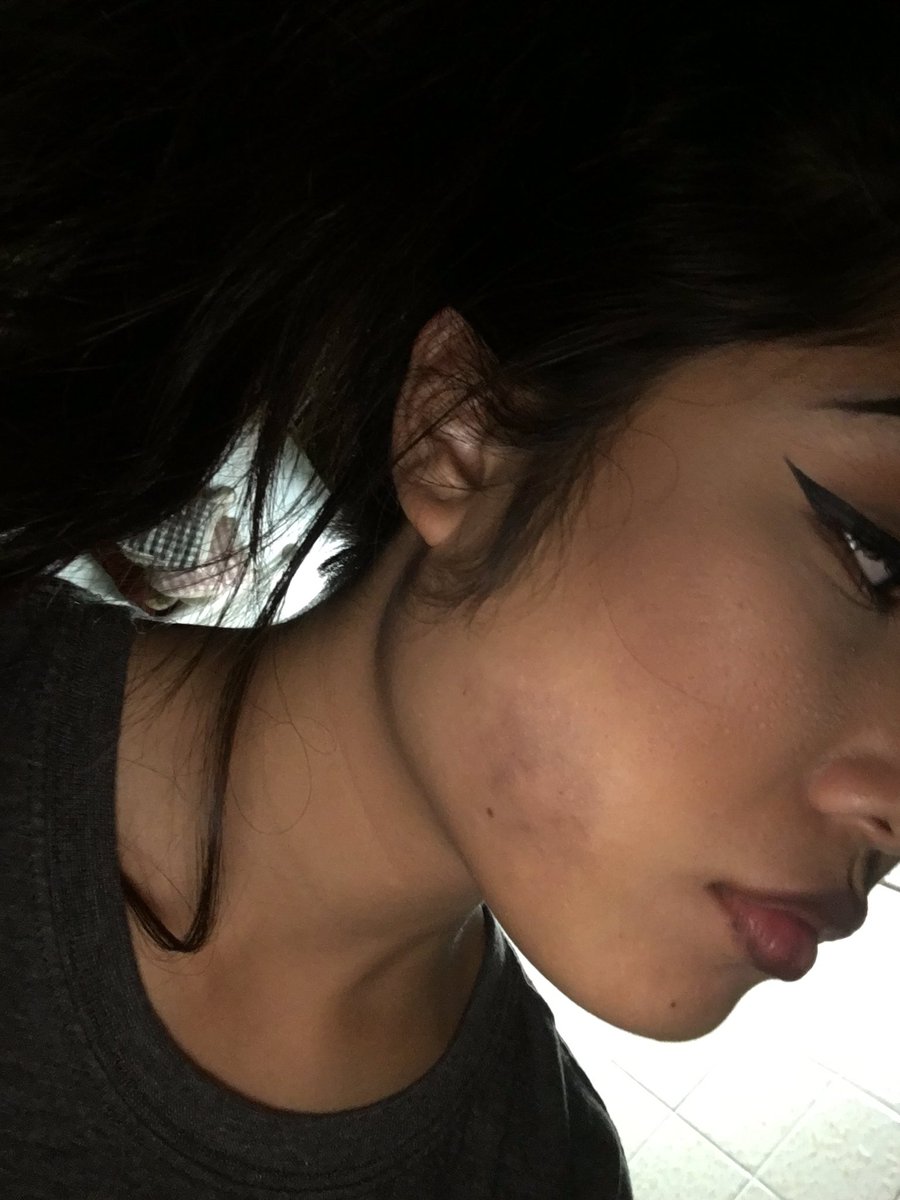 Waking up to a fat bruise after the guy punched me last night