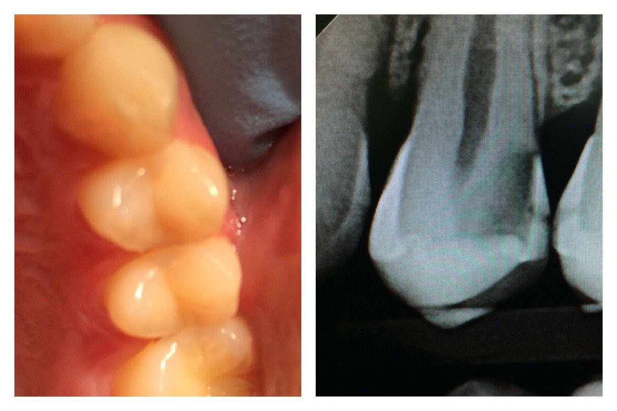 This is why your #dentist takes x-rays. You can see by the photo the teeth look fine but on the radiograph is decay.