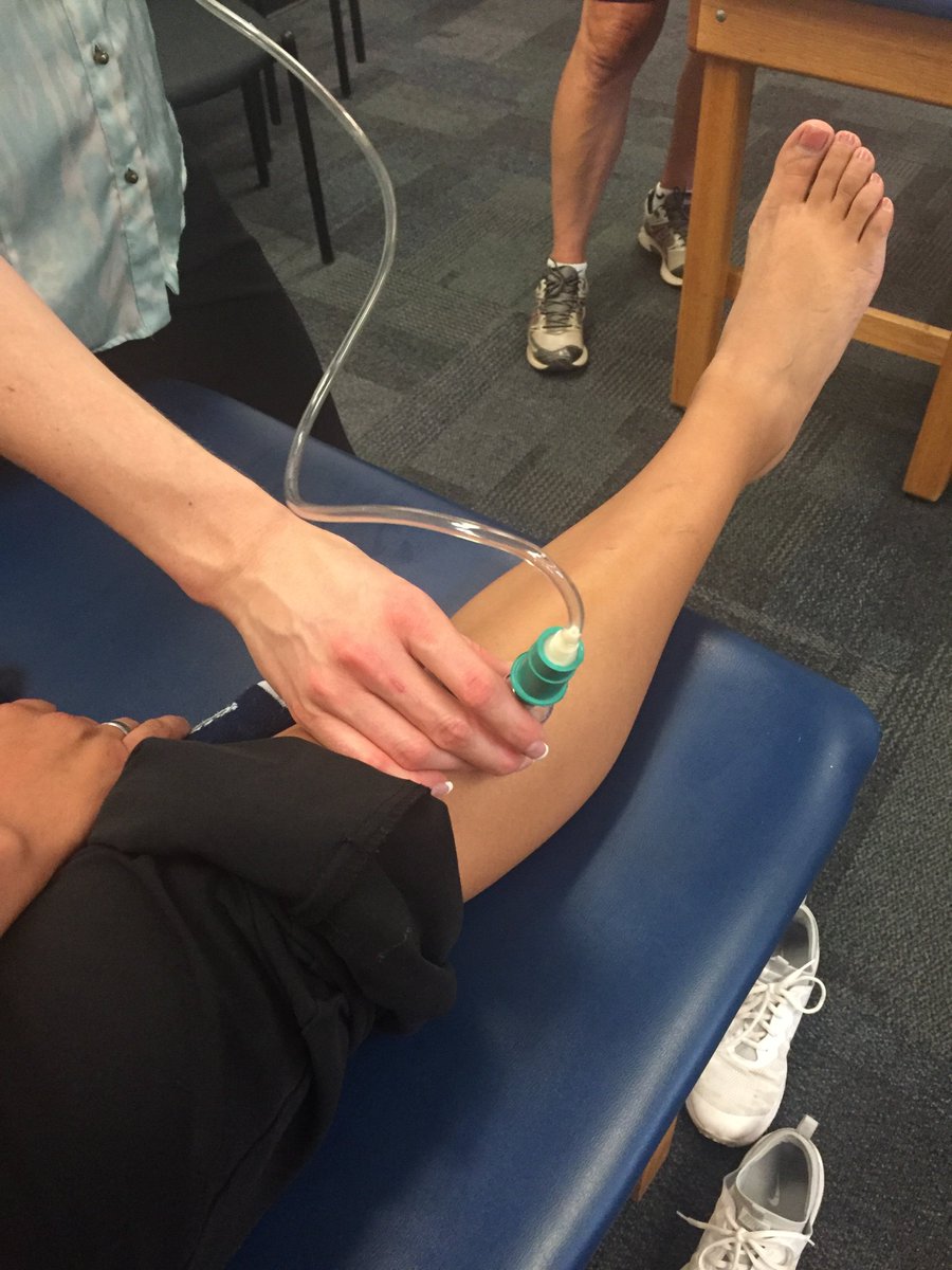 AzATA_News's tweet photo. Finishing up the day with Myofascial Decompression Therapy (Cupping) #AzATA2016 https://t.co/7D7VQld58e