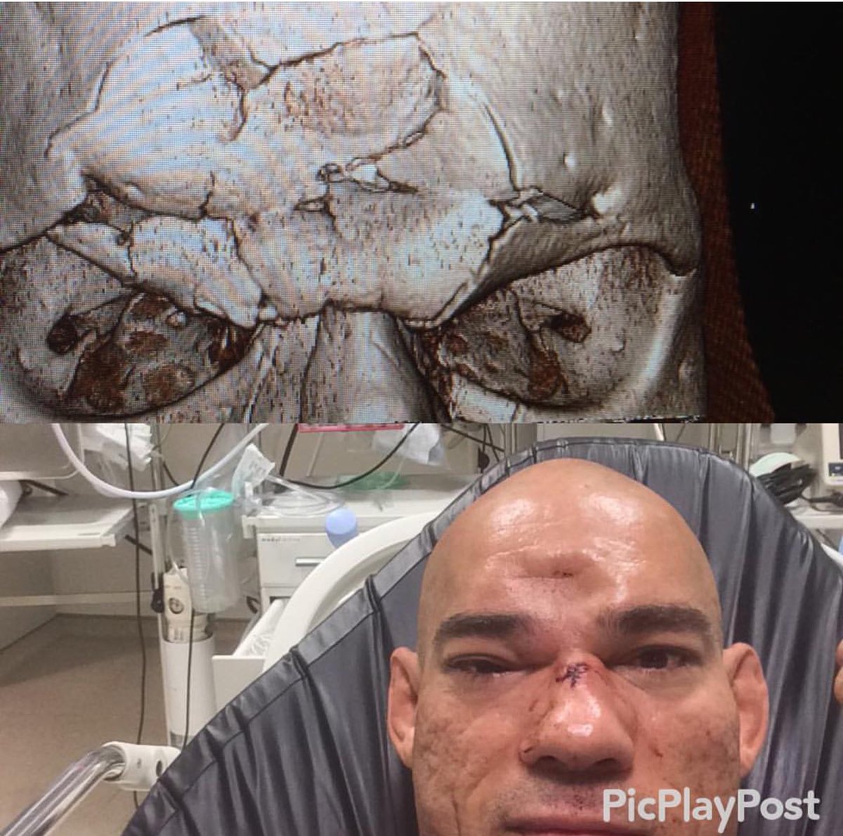 AllThatMMA's tweet photo. Michael Page literally broke Evangelista Santos's skull.

Let's wish and pray for Santos to have a speedy recovery. https://t.co/xI1y3YCaxi