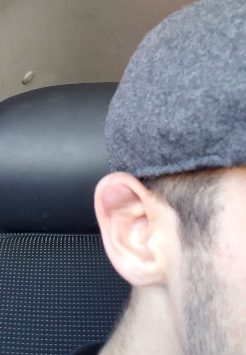 slay_the_lion's tweet photo. Yep, #cauliflowered it! #bjj #grapple #jiujitsu #gettingtournamentready #fightlionslikealion #cauliflowerear https://t.co/mteqR64zMh