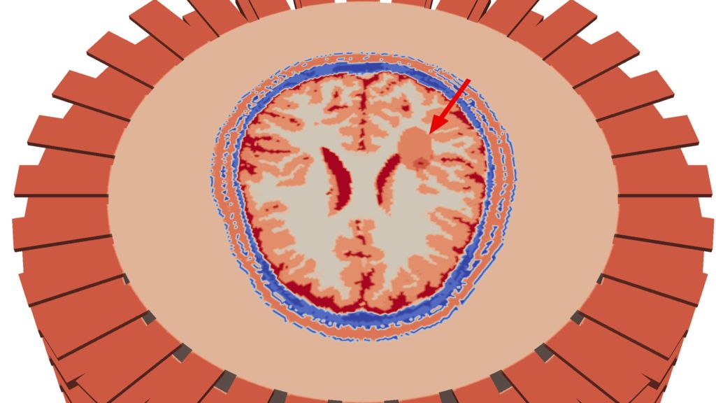 BBCScotlandNews's tweet image. .@UniStrathclyde helps to develop speedier stroke diagnosis bbc.in/2a1FbBn