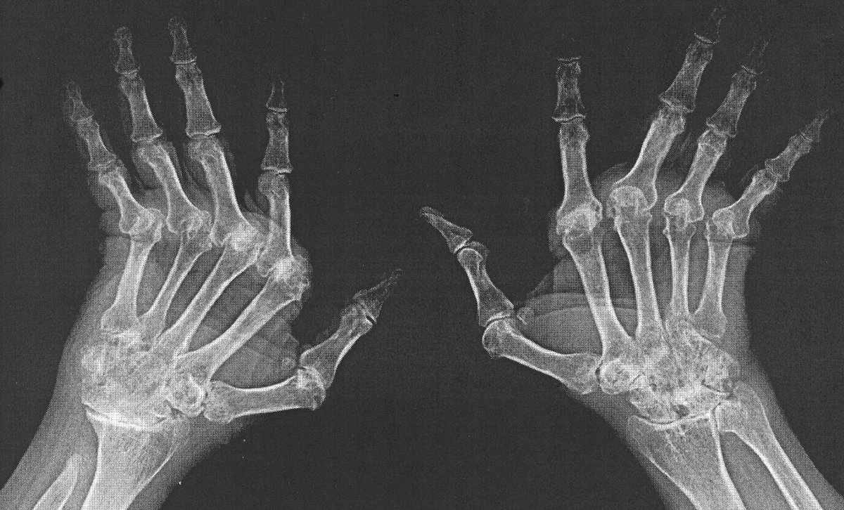 Ревматоидный артрит суставов кистей. Ревматоидный артрит кисти рентген. Полиартрит рентген кистей. Ревматоидный артрит лучезапястного сустава рентген. Ревматоидный полиартрит рентген кистей рук.