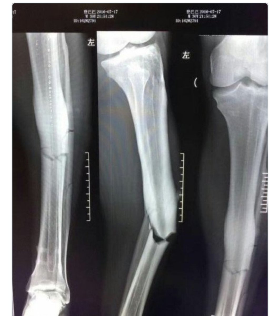 Wan On Twitter Xray Demba Ba Punya Kaki Lps Injured Holycow Syafakallah Bro