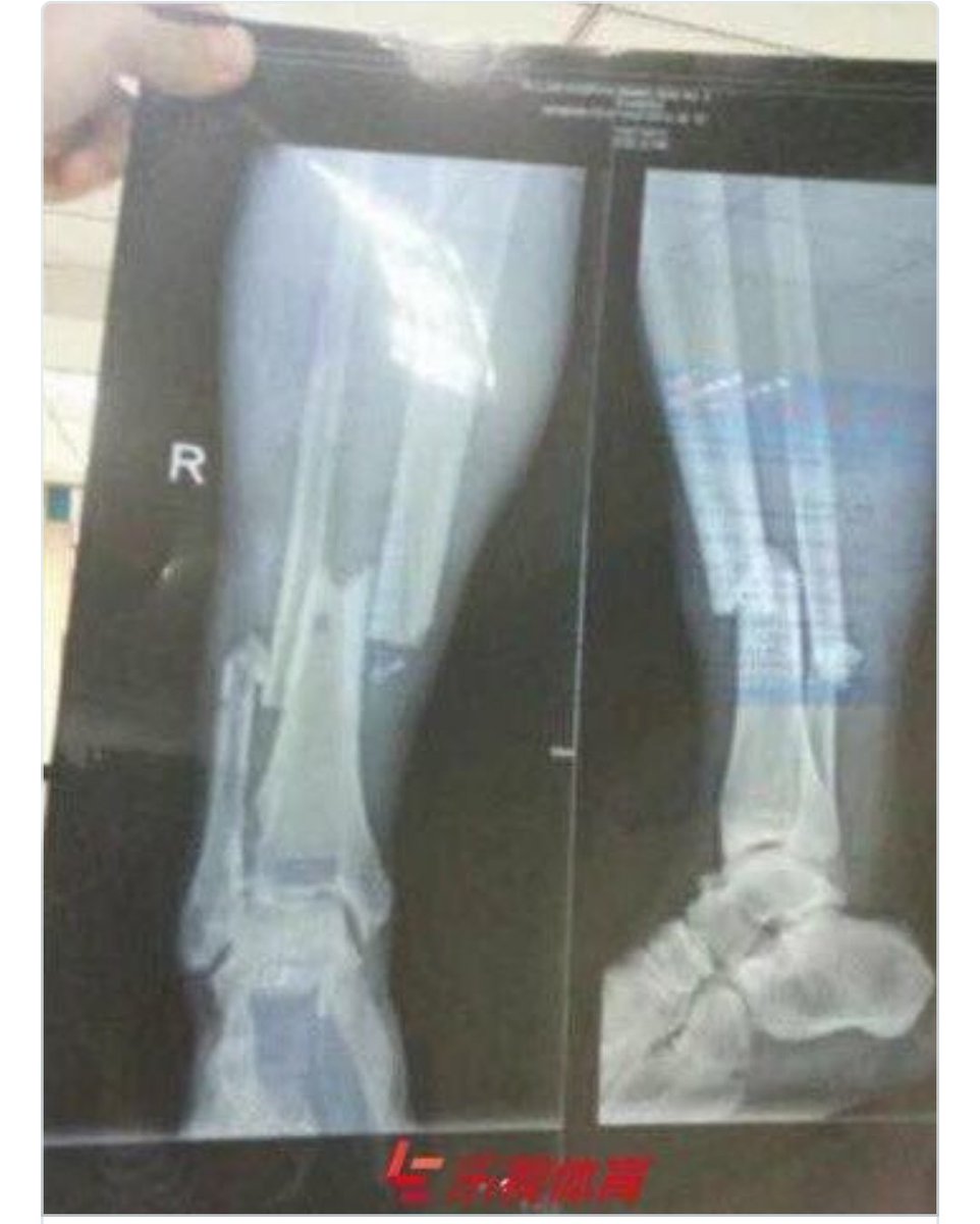 Wan On Twitter Xray Demba Ba Punya Kaki Lps Injured Holycow Syafakallah Bro