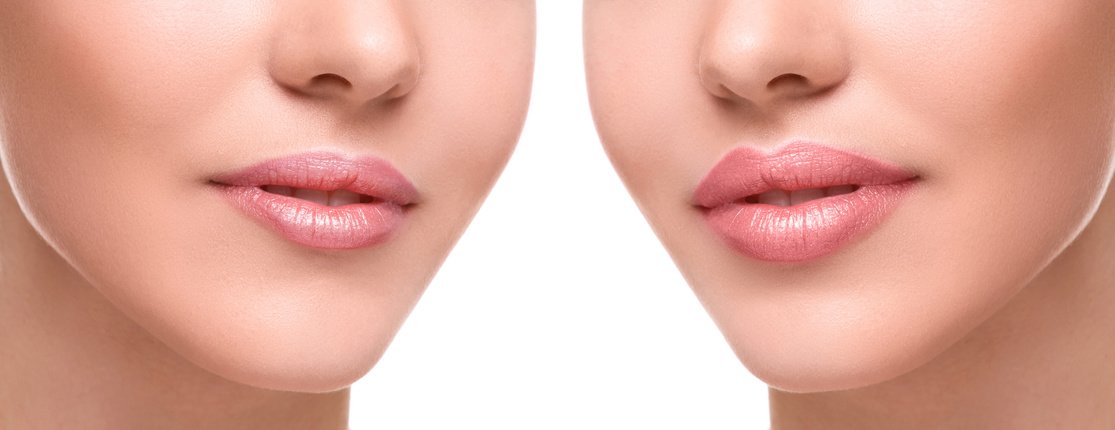 AestheticFirst's tweet image. #Lippenvolumen durch #Kollagen #Lipfiller mit Glosseffekt bei Aesthetic First in Köln.
aesthetic-first.com/lippenformung/…