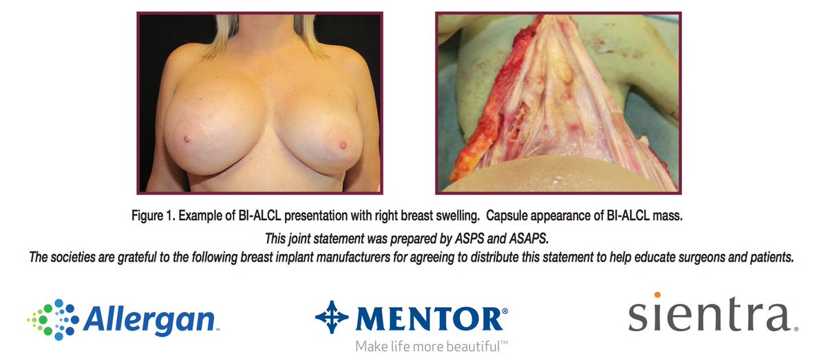 DanMillsMD's tweet photo. Important joint update on #ALCL, a #breastcancer seen in #breastimplants by @@ASAPS @ASPS_News https://t.co/9j5GUFxcSw