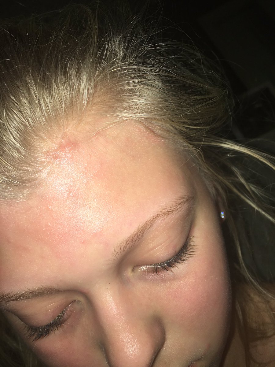 beechloren00's tweet photo. I keep having these allergic reactions and I'm so sad right now . it hurts . https://t.co/o8sOPMUNJX