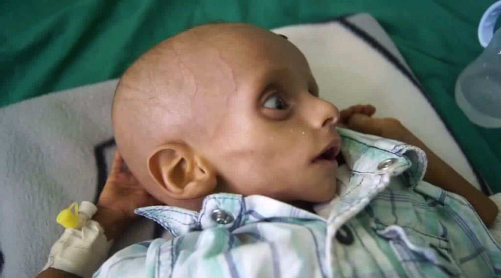 YemenPostNews's tweet photo. War &amp; HUNGER: 80% of #Yemen children sleep hungry after 490 days of Saudi war that tears country apart. #اليمن https://t.co/zSNMHQGZW6
