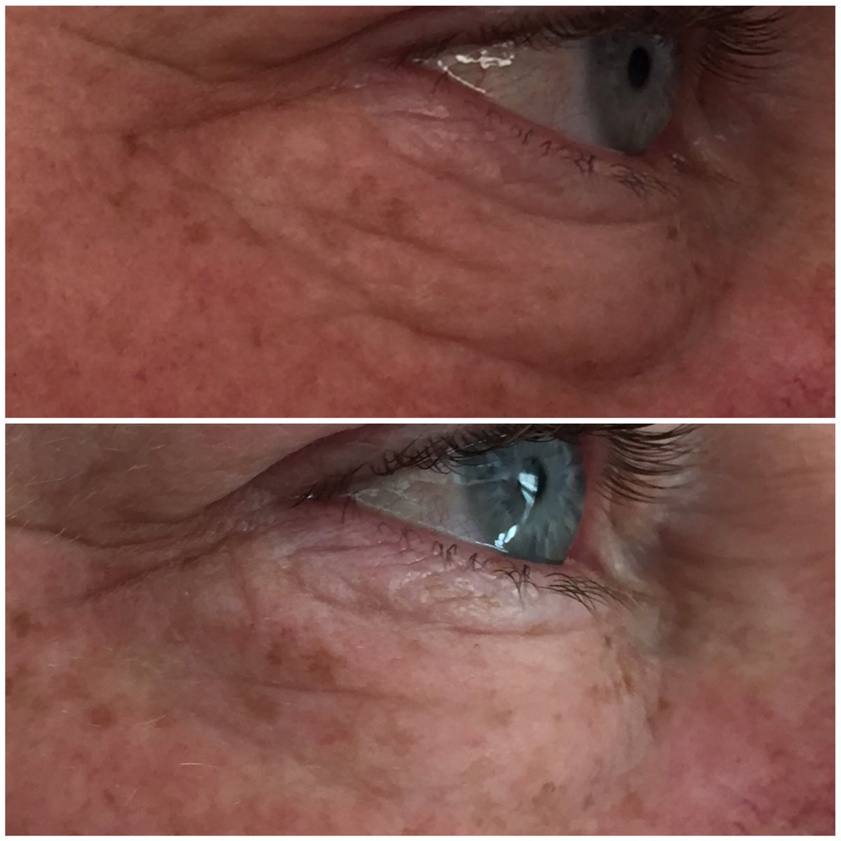 coachlorrimack's tweet photo. This is my husbands 5 min results! Can u relate to bags? Message me how to get rid of them no Botox! #skincare #skin https://t.co/iNgrfbYqXS