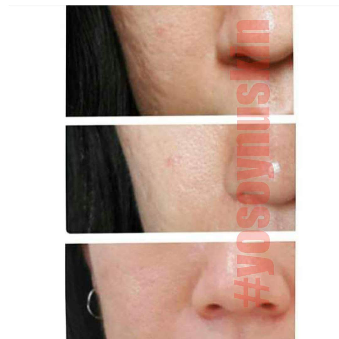dianis925's tweet photo. Eliminar las cicatrices del acné SI es posible. #nuskin #galvanicafacial. Whatsapp +57 3006791619 https://t.co/nLwWtVyuQZ