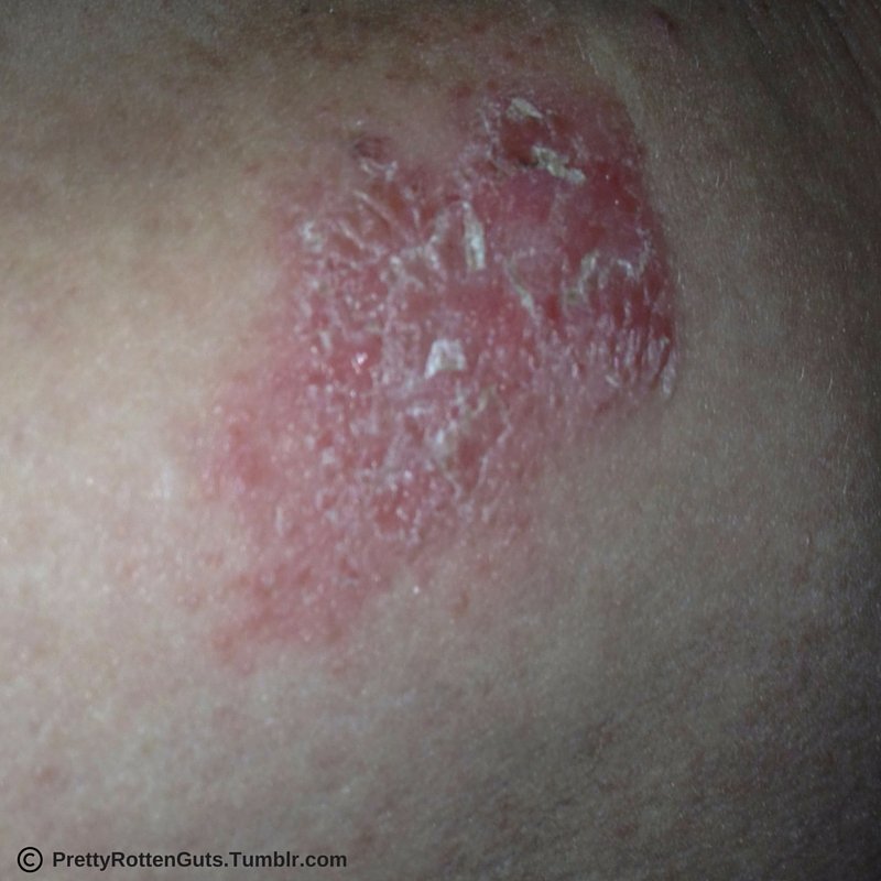 psoriasis and crohn's