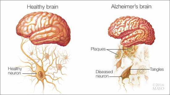 MayoClinic's tweet photo. Q. How early can #Alzheimers be diagnosed? What are early symptoms? @RonPetersenMD replies. https://t.co/lQZvVIymiO https://t.co/5PlQOZyVvi