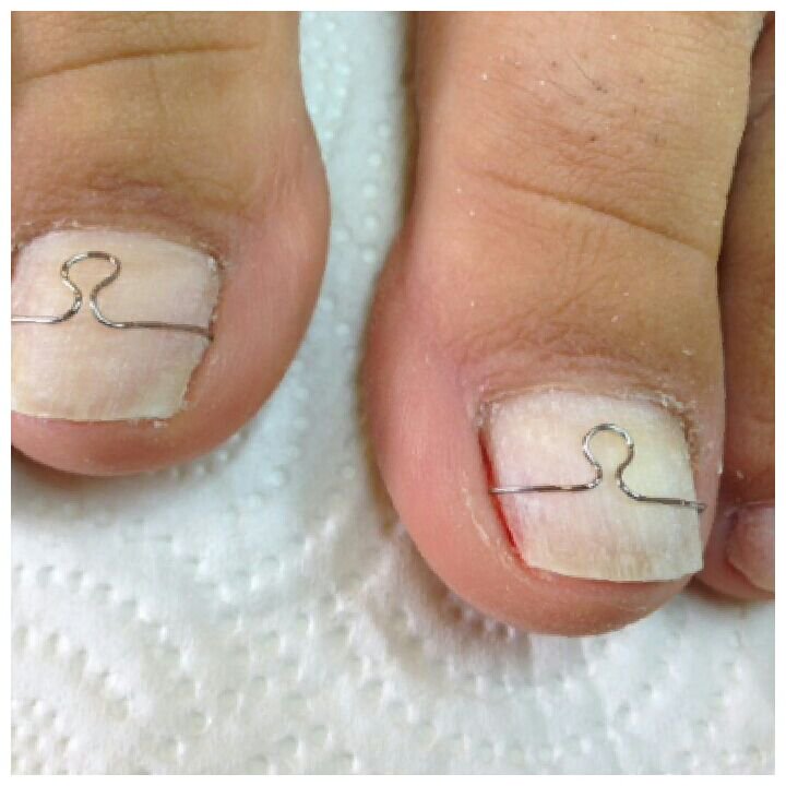 Batık Tırnaklarınız için çile çekmeyin !