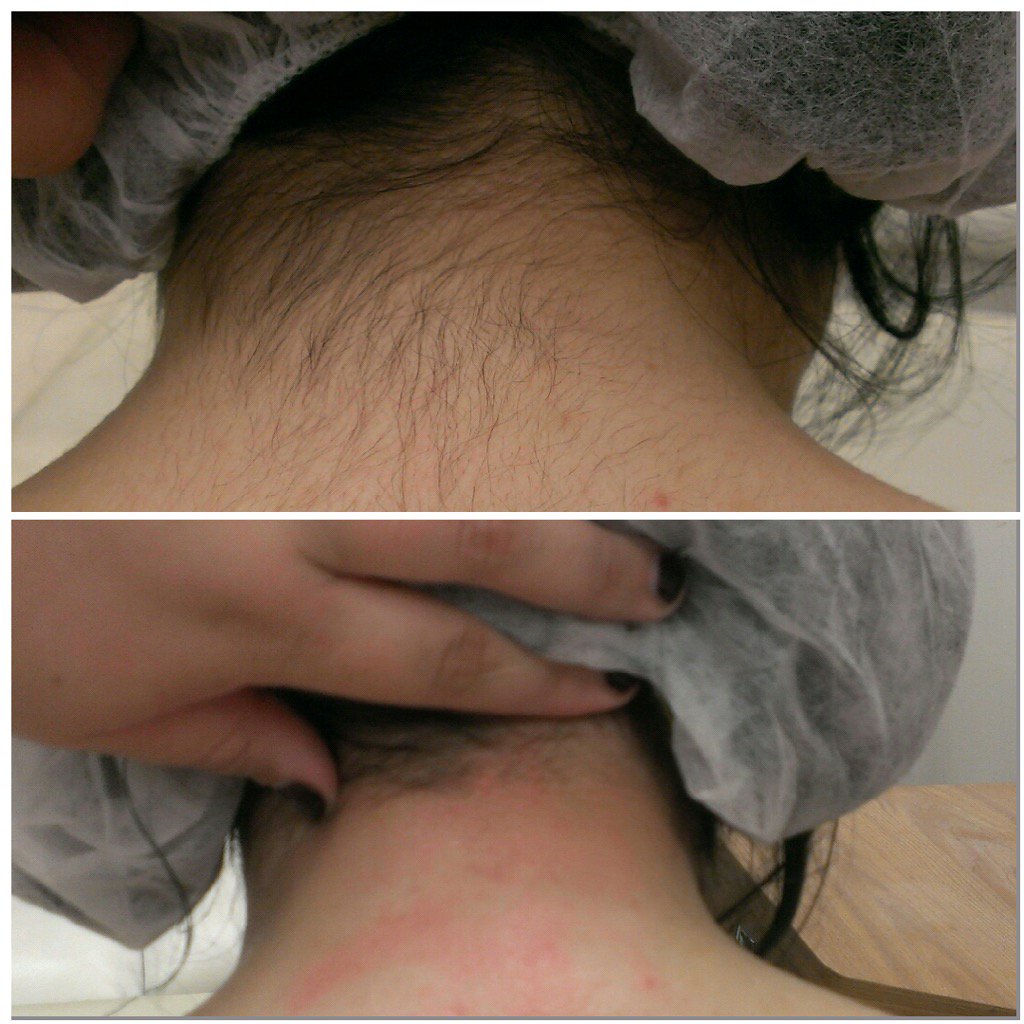 TheSkinParlour's tweet photo. #WaxOnWaxOff #BabyHairs #NeckLine #SeBrazil #CocoDiva #Latte #OuchBalm #TheSkinParlour @sebrazilwax @stephanielaynes https://t.co/7kQ60II7OD