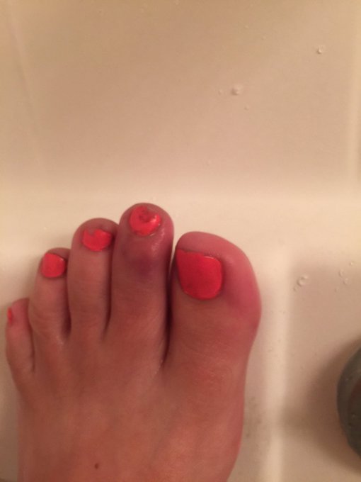 Ouch! My poor hurt long toe... ☹️😖 https://t.co/YXOI0VwT5A<a href="/tag/nutrition"class="tags"><span>#nutrition</span></a><a href="/tag/success"class="tags"><span>#success</span></a>