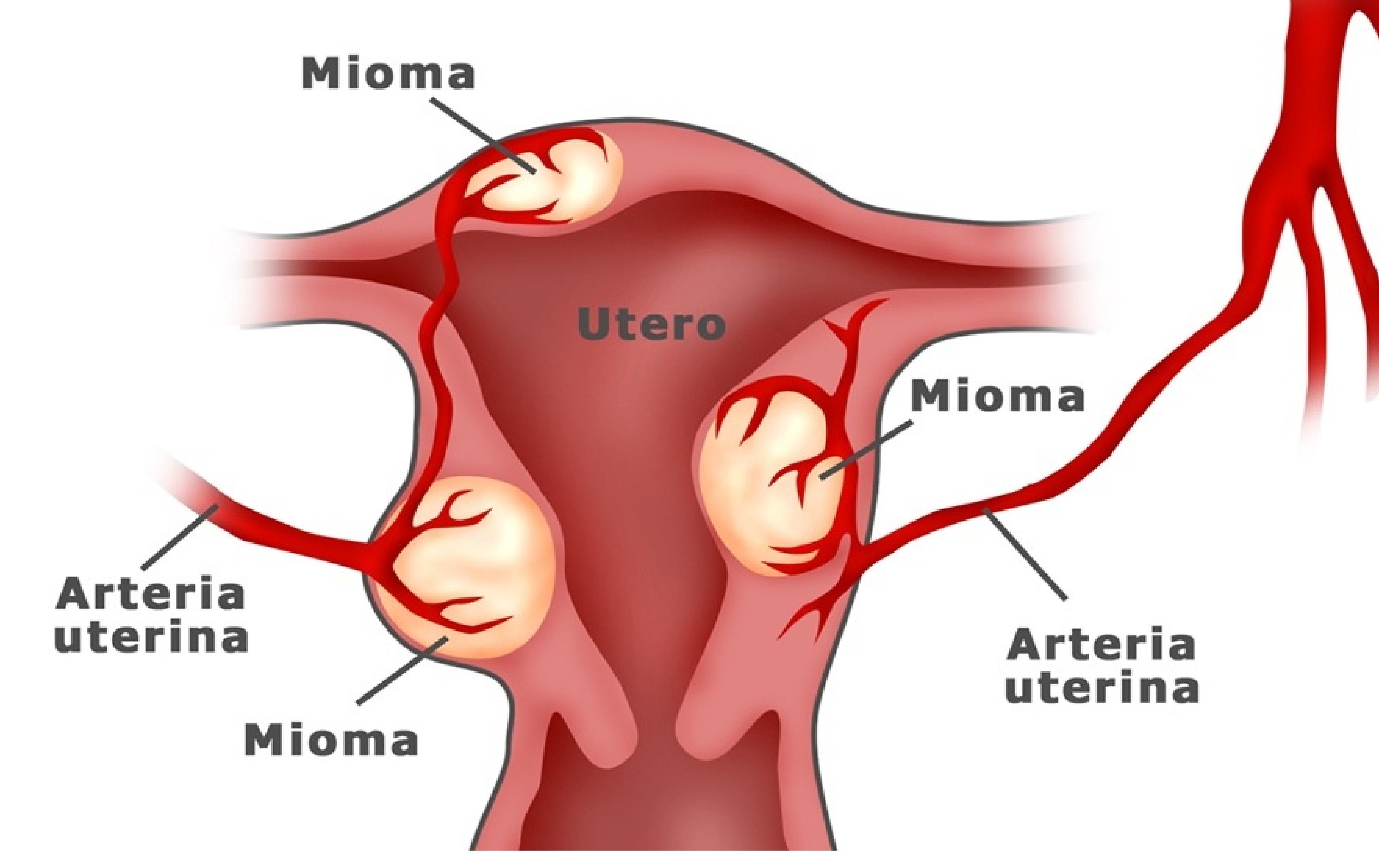Alimentacion para miomas uterinos