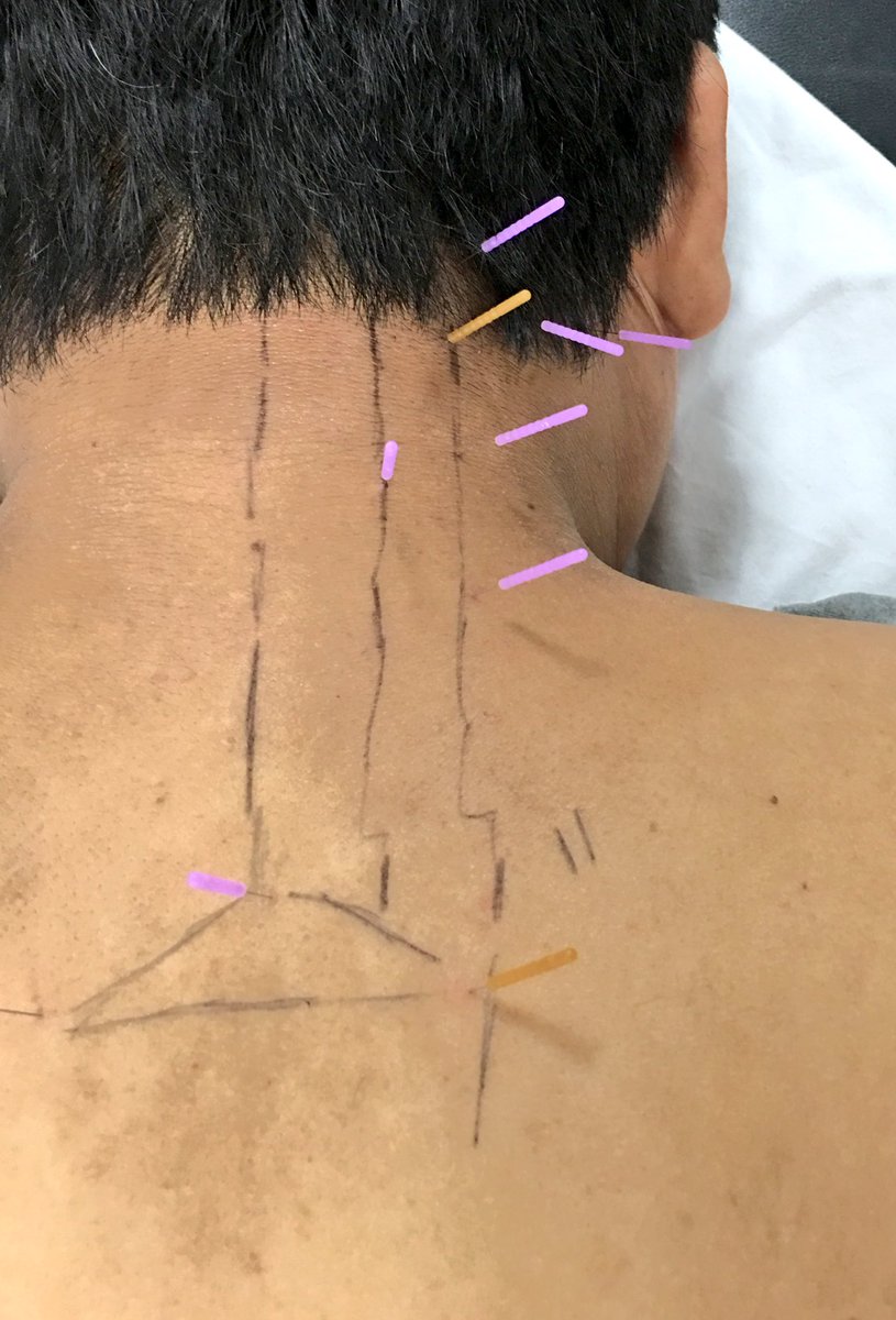 TommyDPT's tweet photo. @dryneedling for MNP with multiple needles in situ with 20+ PTs and @osteopractor (s) in training DN-1 Stamford https://t.co/4Rzqt2BLU6