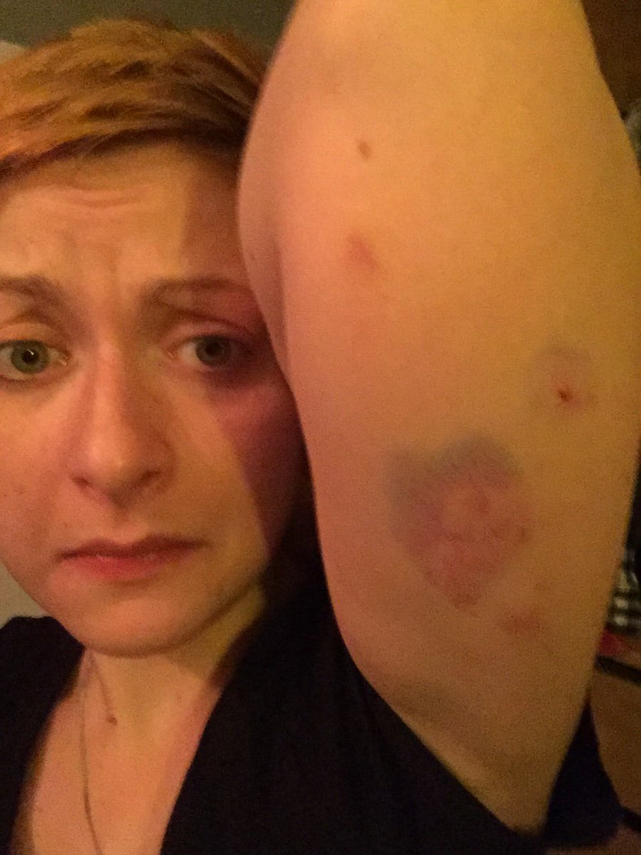 sailor_jerry's tweet photo. Got battered by an old lady #NursingLyfe https://t.co/XFjKZZKj8m