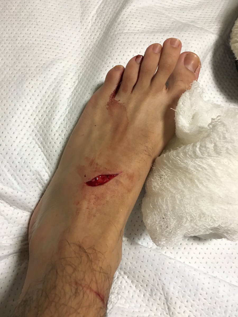 Andres_FSU's tweet photo. Even though I had a rough weekend, at least I didn't cut my fingers!! Typing away... #summer2135 https://t.co/71kVMbrB14