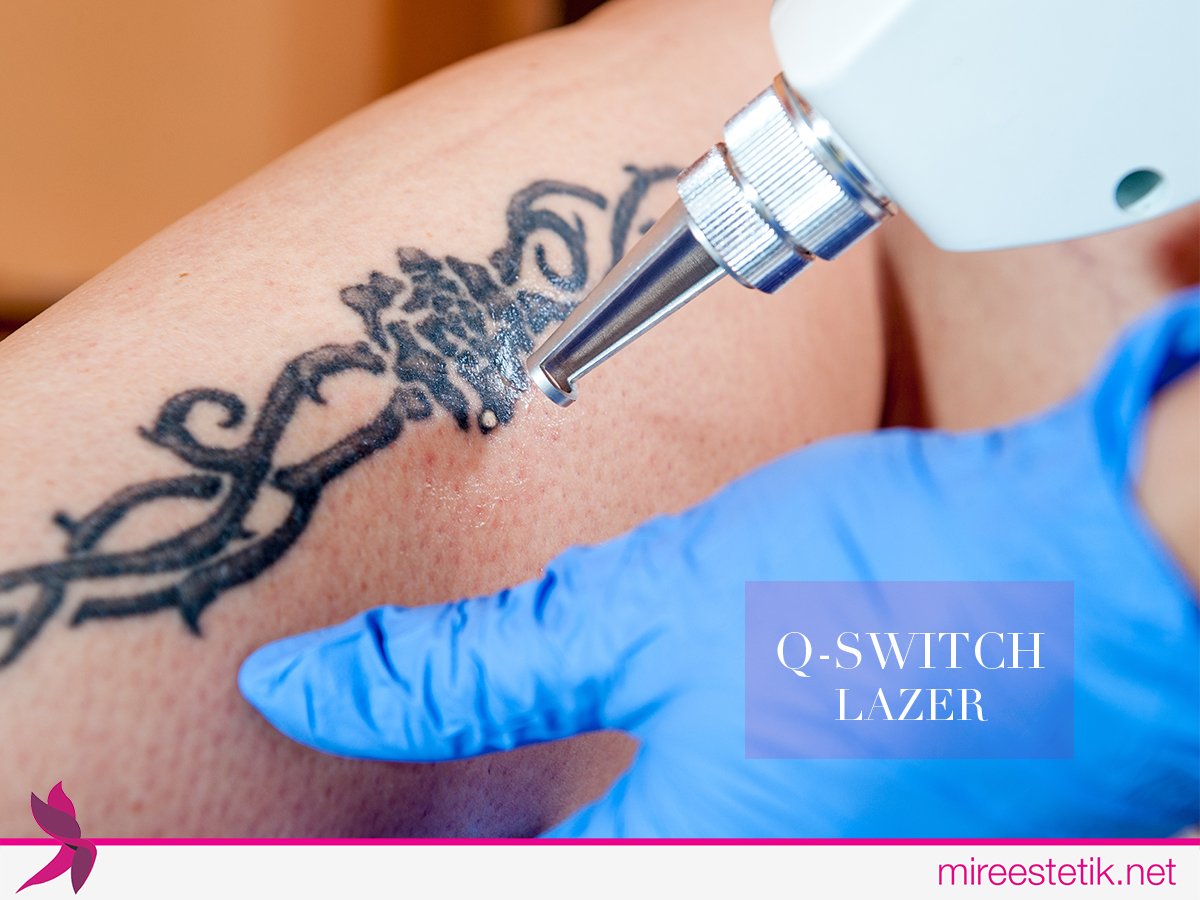 Q-switch lazer tekniği dövme sildirmenin en etkili yoludur. Detaylı bilgi için: ow.ly/FTzN302zll9