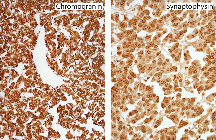 MayoClinicPath's tweet image. 👏 @rehdam @lara_pijuan :LG Neuroendocrine carc w/Oncocytic fts|70M Lung|Cred @therock275 | ow.ly/tp4K301nC5O