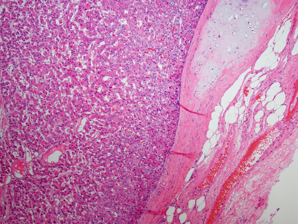 MayoClinicPath's tweet image. 👏 @rehdam @lara_pijuan :LG Neuroendocrine carc w/Oncocytic fts|70M Lung|Cred @therock275 | ow.ly/tp4K301nC5O