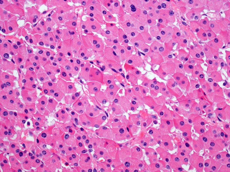 MayoClinicPath's tweet image. 👏 @rehdam @lara_pijuan :LG Neuroendocrine carc w/Oncocytic fts|70M Lung|Cred @therock275 | ow.ly/tp4K301nC5O
