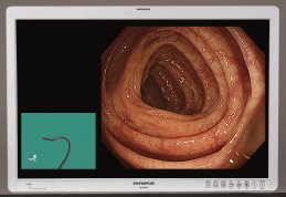OlympusMedUKIE's tweet photo. #ScopeGuide allows for greater effective loop management in #colonoscopy, while reducing patient discomfort (1/2) https://t.co/5nQXbthgCT