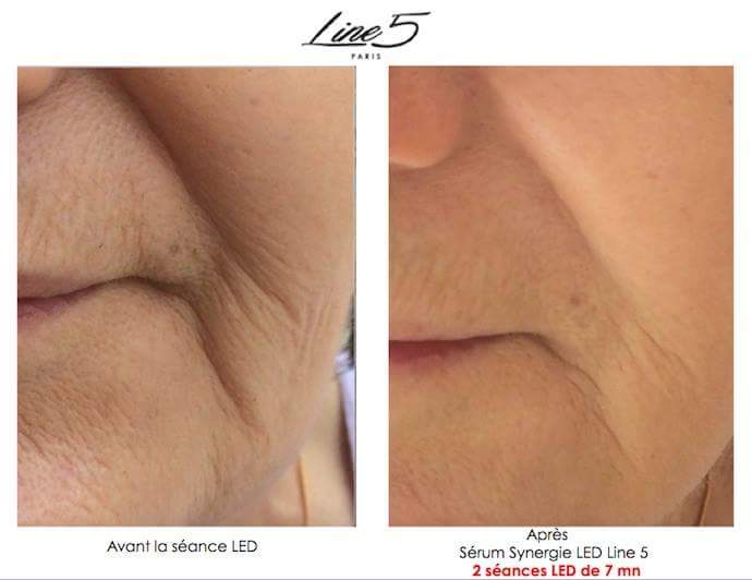 Line5Paris's tweet image. Après 2 séances LED (Pad Cosmetique Line 5 Paris). 
Inscrivez vous: contact@line5paris.com