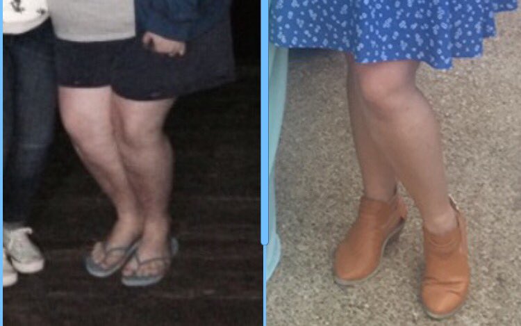 deshaychey's tweet photo. So gross but #legprogress π¬ https://t.co/SivKypqfCb